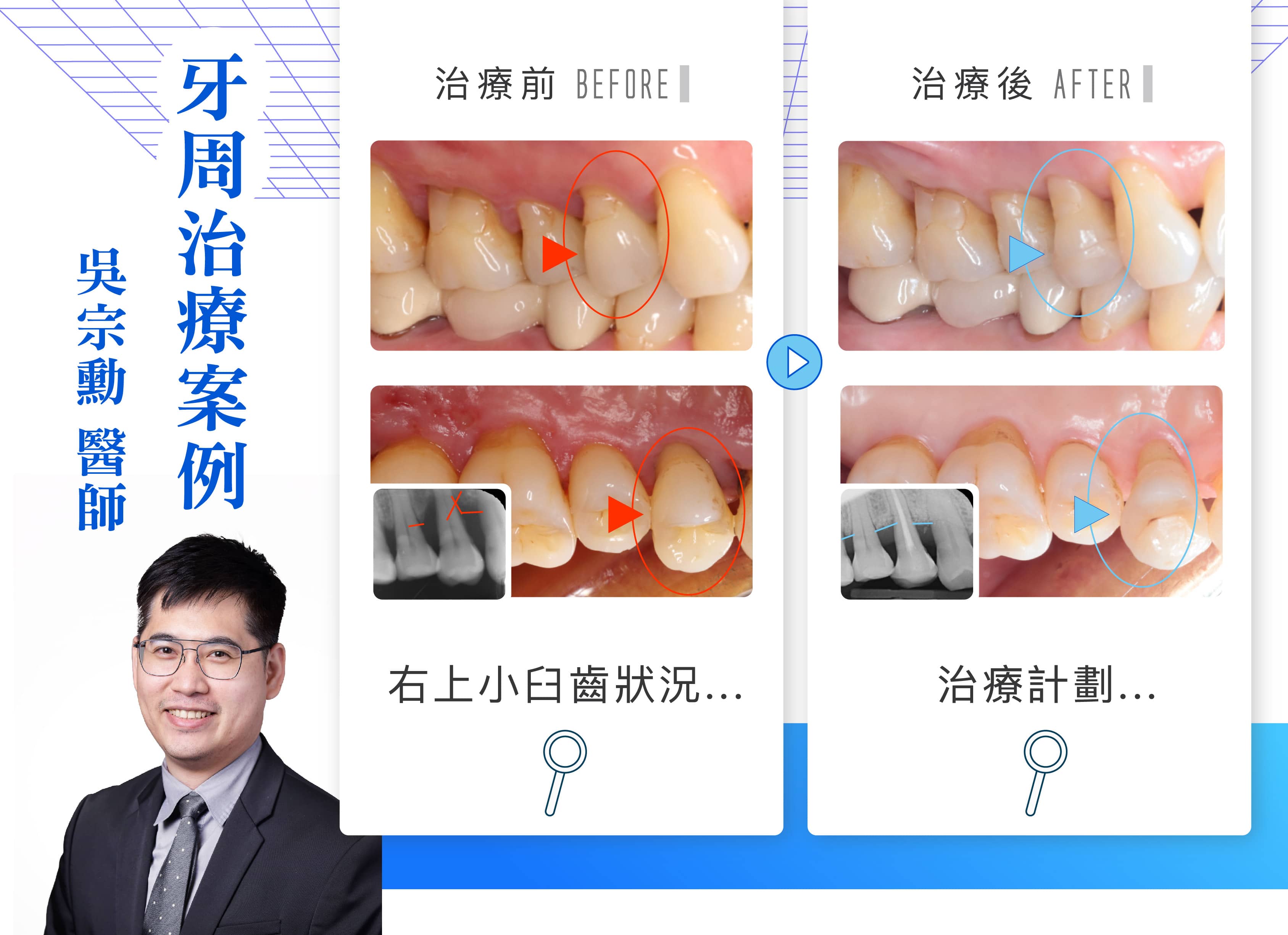 吳宗勳醫師-牙周治療案例分享