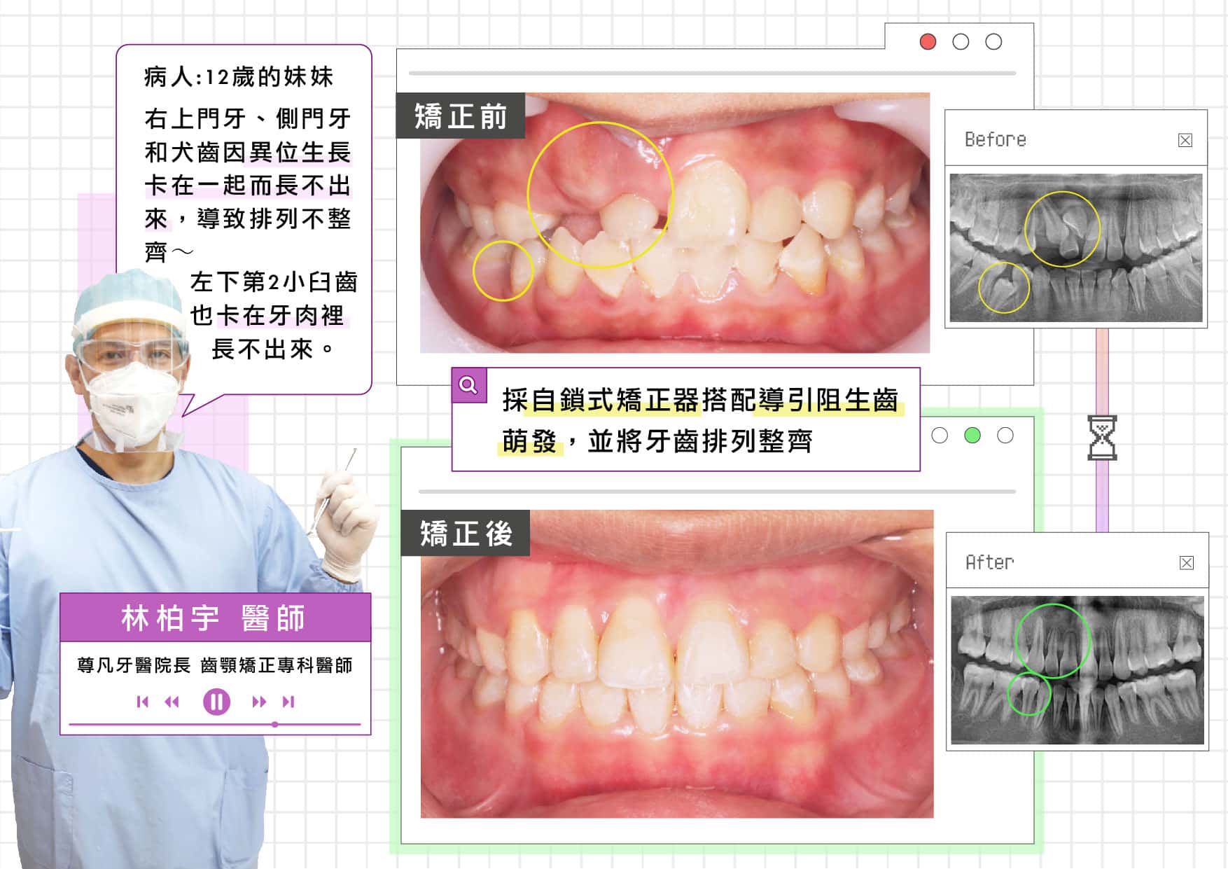 12歲妹妹的阻生牙矯正案例