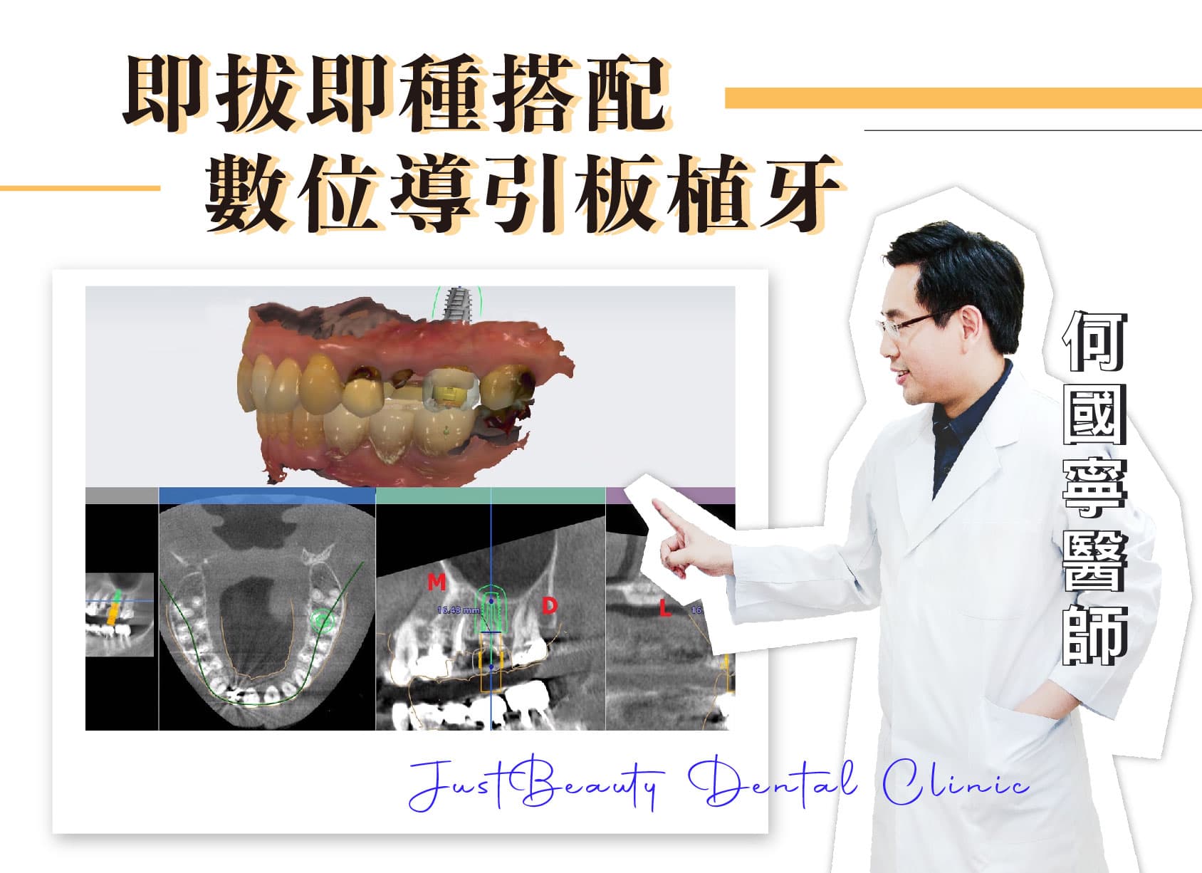 植牙案例-即拔即種搭配數位導引板