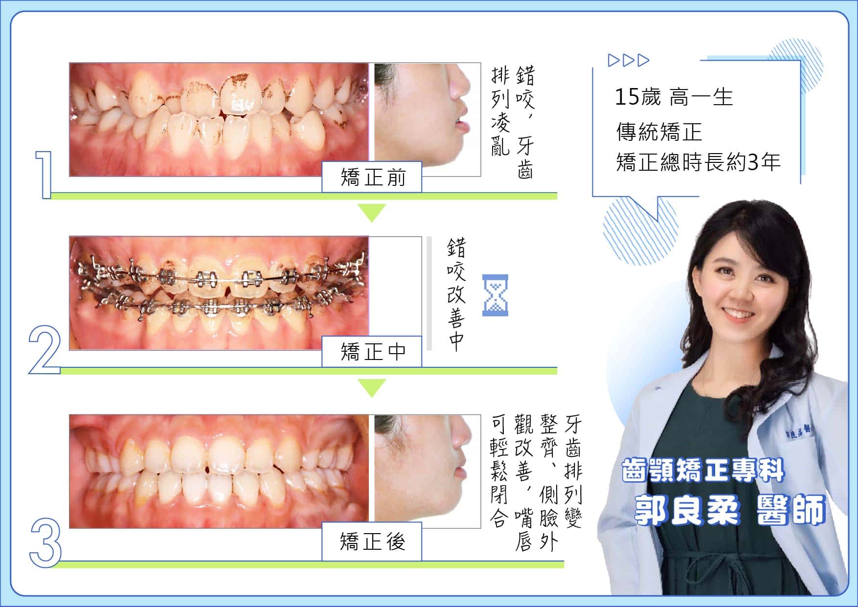  新莊爵美牙醫 郭良柔醫師矯正分享