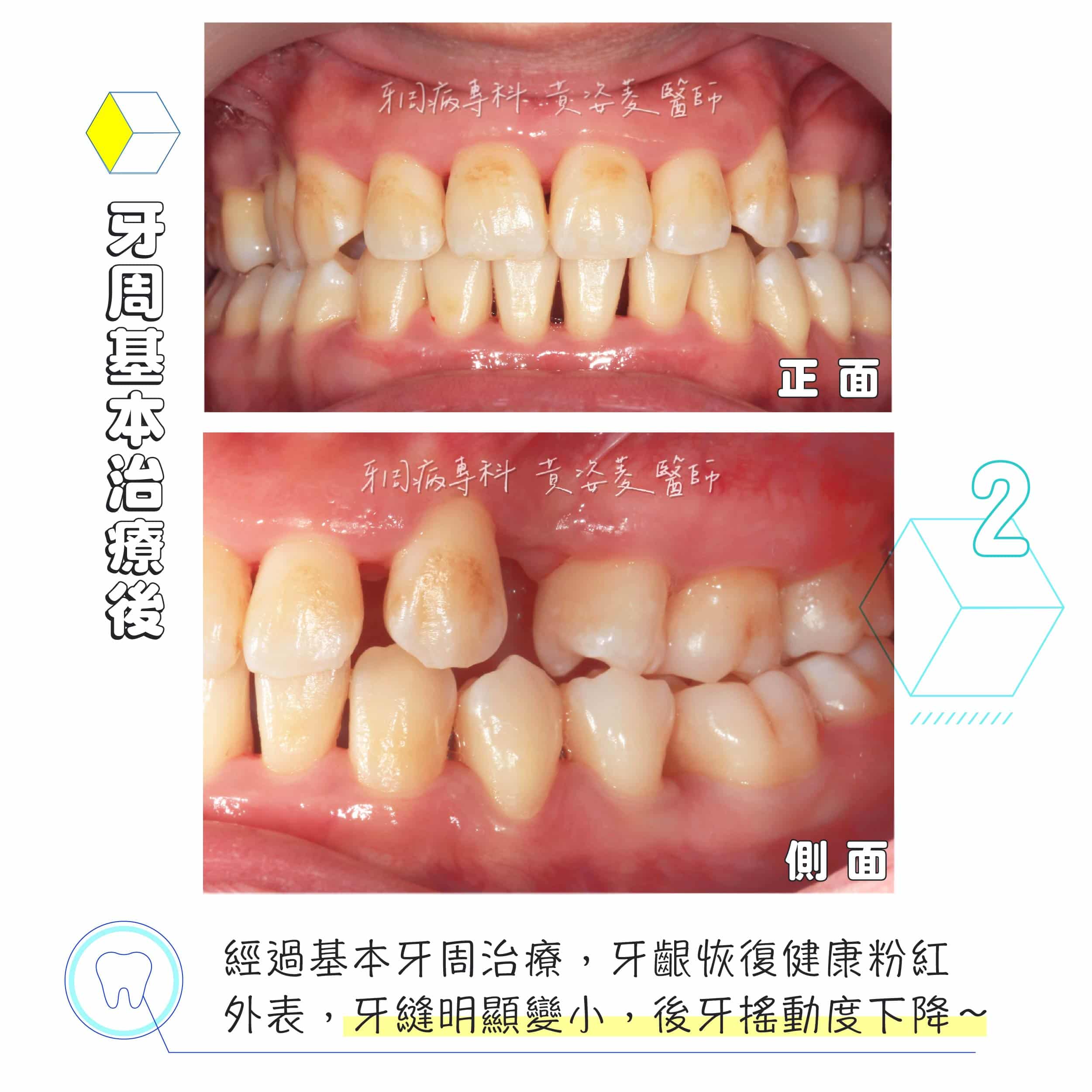 黃姿菱醫師 牙周治療案例分享