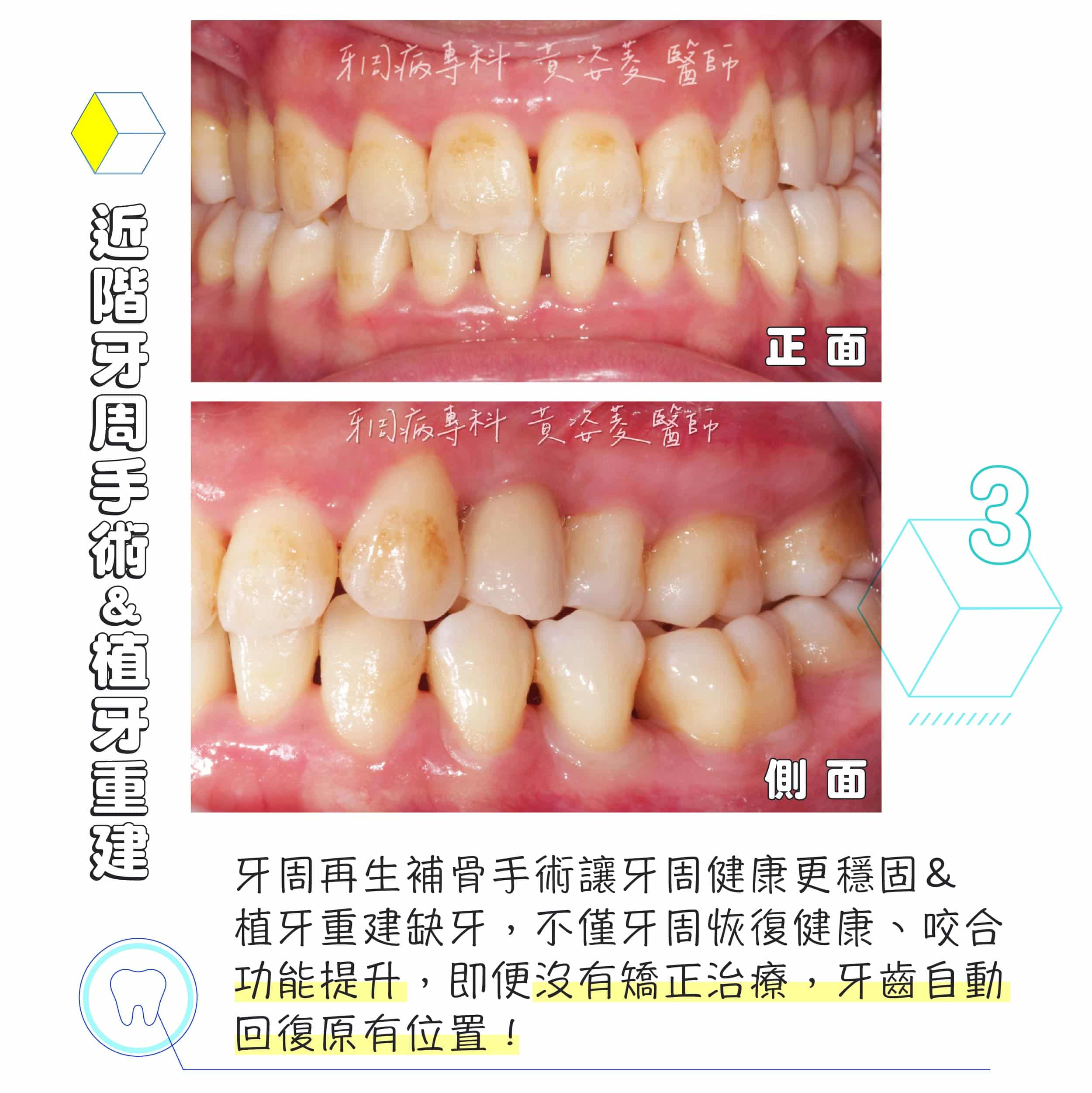 黃姿菱醫師 牙周治療案例分享