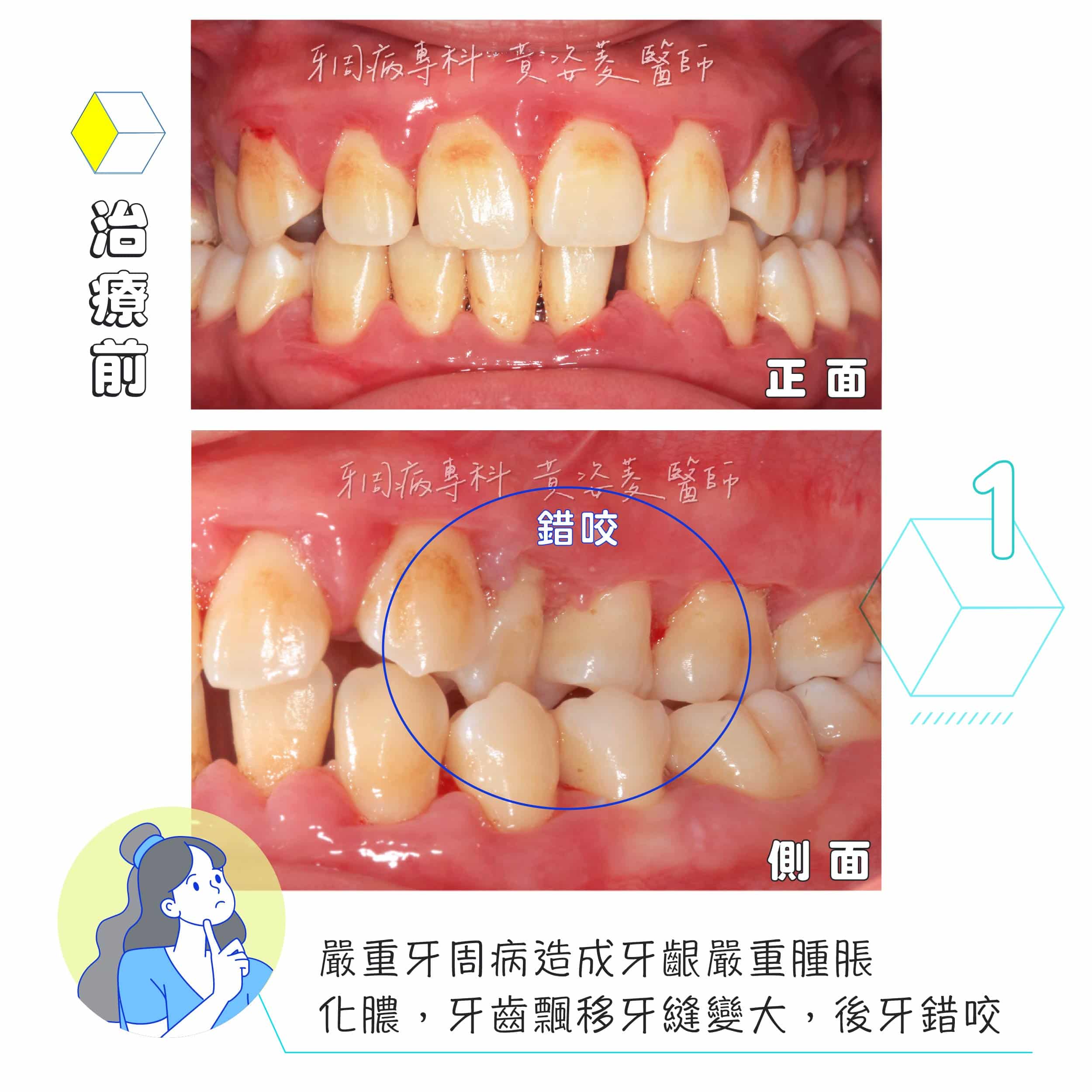 黃姿菱醫師 牙周治療案例分享