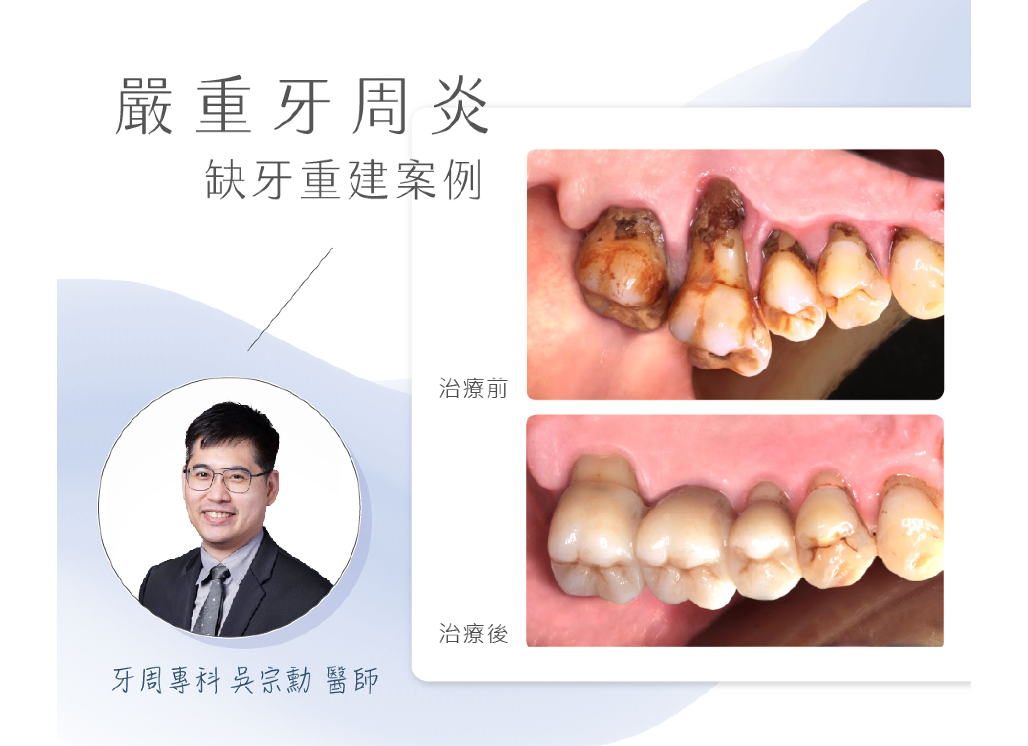 ❙ 咬合功能重建-全瓷牙橋  ❙ 牙周專科  吳宗勳醫師 案例分享